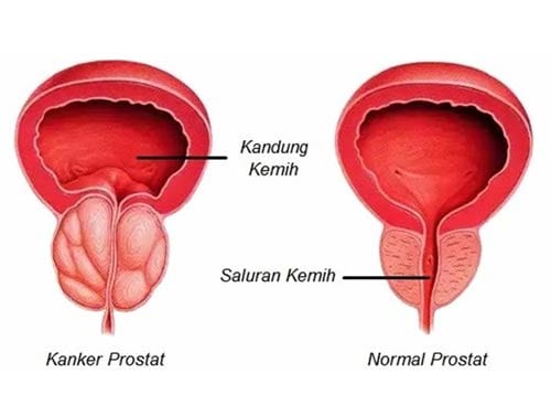 Penyakit prostat